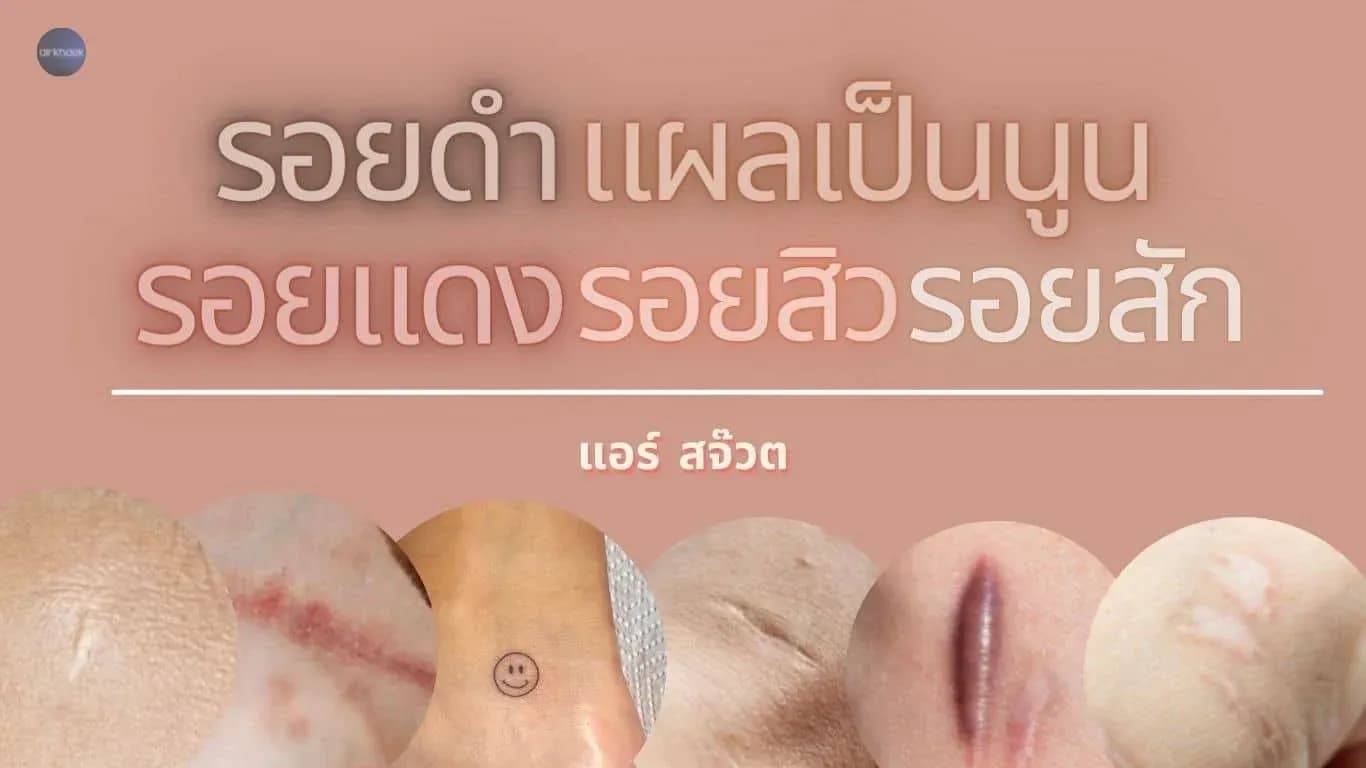 รอยสัก รอยแผลเป็น รอยนูน รอยสิว รอยดำ รอยแดง กับ การสมัครแอร์