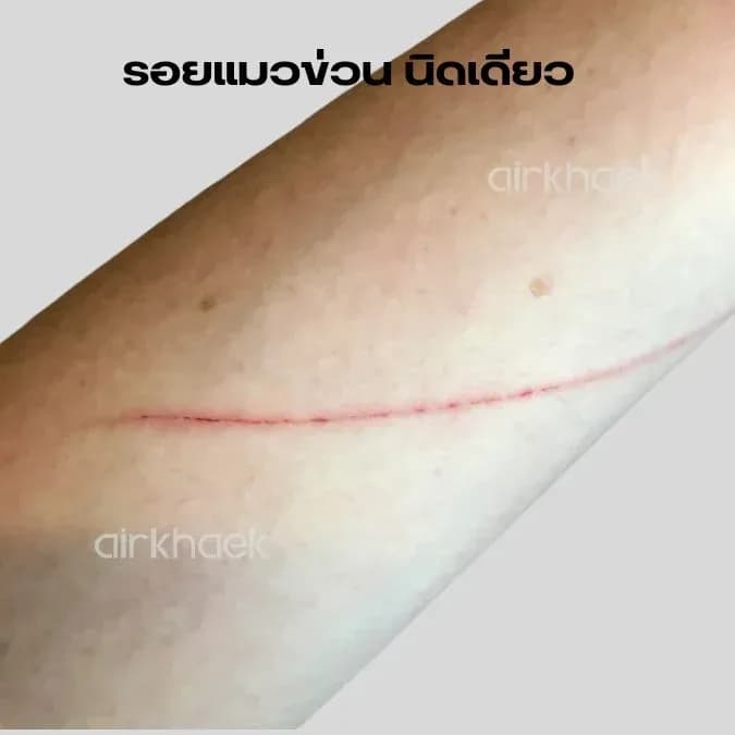 รอยข่วน แผลเป็น สมัครแอร์ สจ๊วต กาตาร์