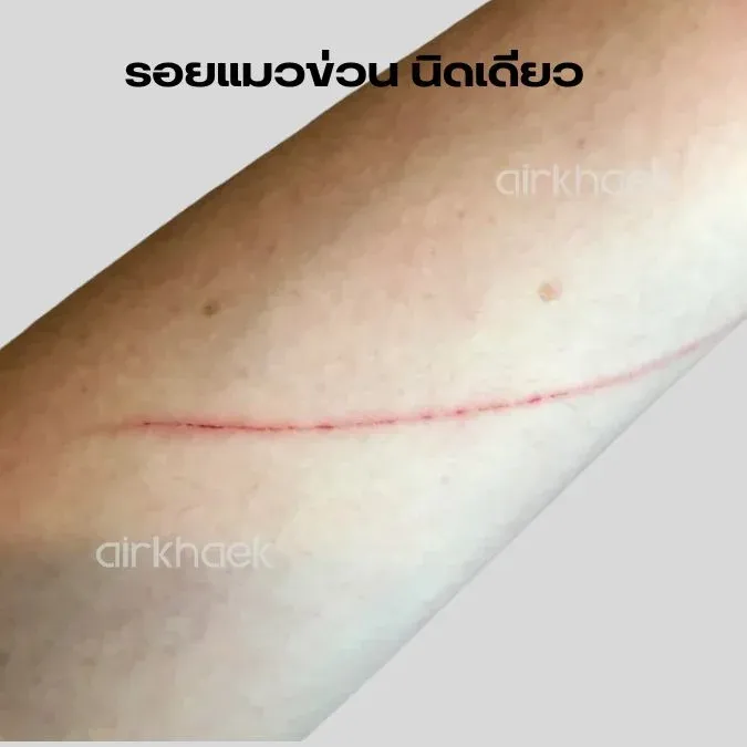รอยข่วน แผลเป็น สมัครแอร์ สจ๊วต กาตาร์