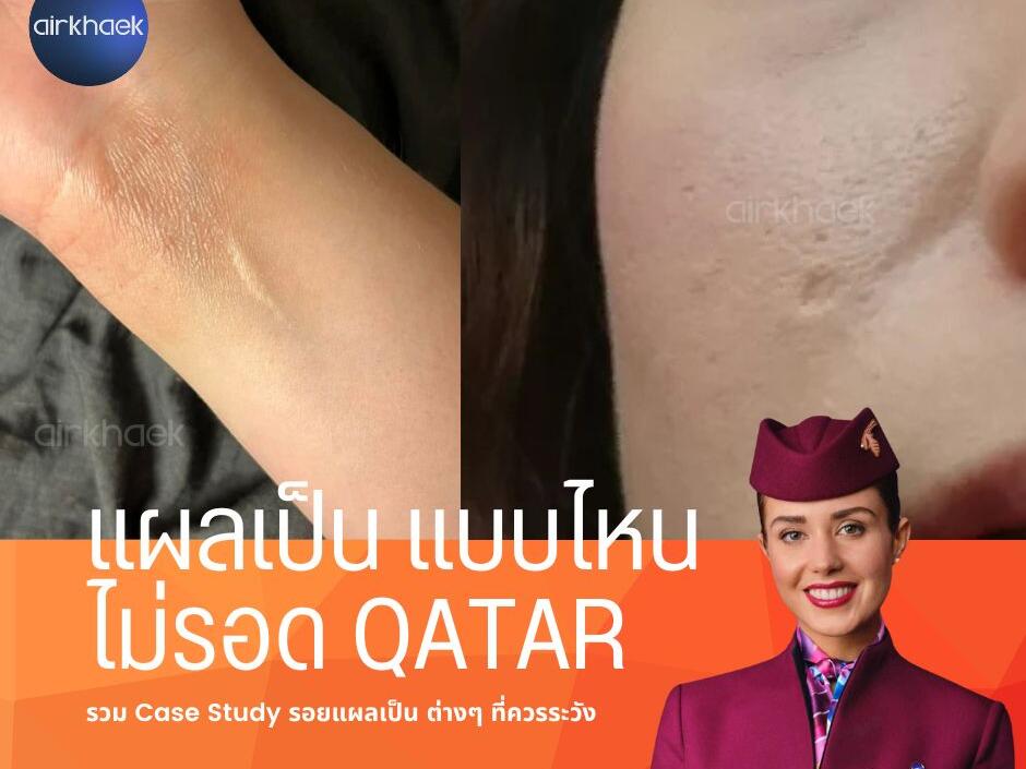 แผลเป็น สายการบิน กาตาร์ Qatar Airways