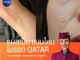 แผลเป็น สายการบิน กาตาร์ Qatar Airways